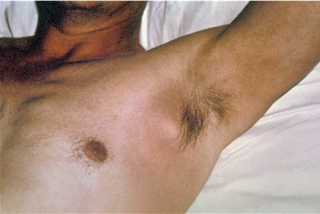 An Axillary Bubo And Edema of a Bubonic Plague Patient