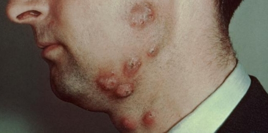 photo of ringworm of the bearded area, tinea barbae, barber's itch